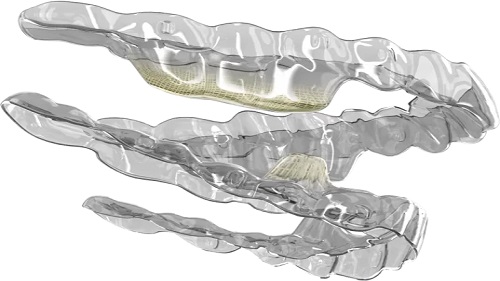 Smartee Teeth Straightening Aligners: Powerful and Effective Treatment Results