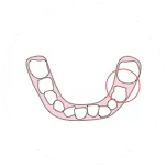 Insufficient space for tooth eruption