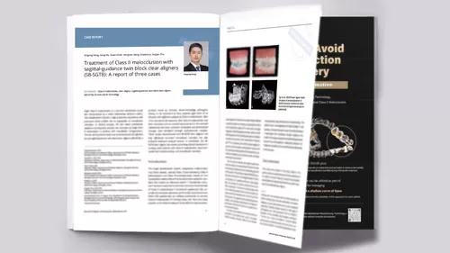 Adult Class II Malocclusion Cases Treated with Smartee S8-SGTB Published in JAO